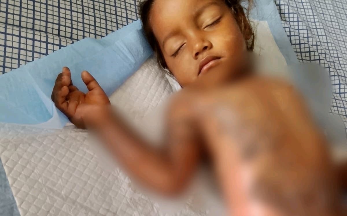 Help 3-Year-Old Mamatha Recover from Severe Burn Injuries