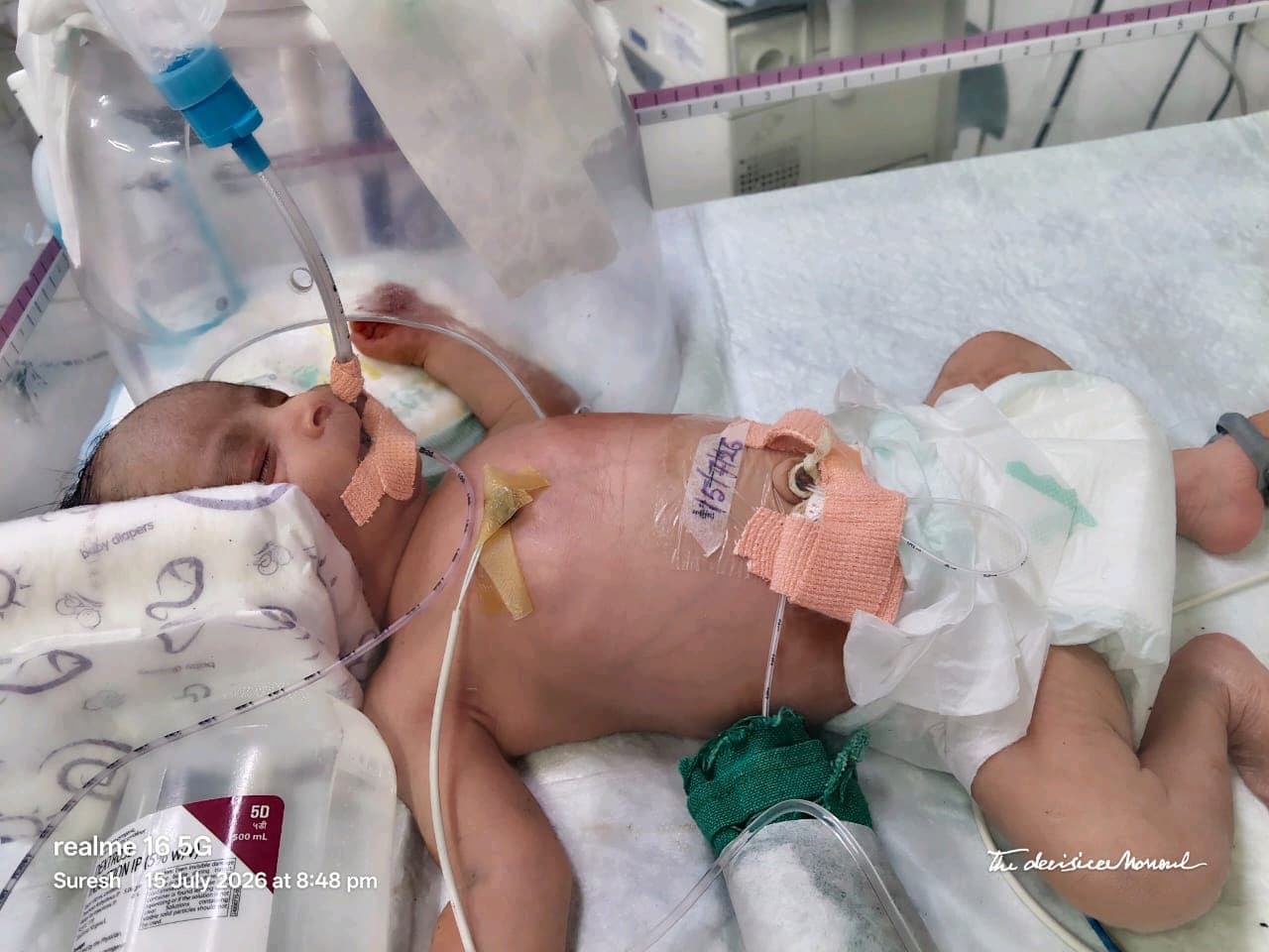 Help Our Premature Baby Boyβs Life