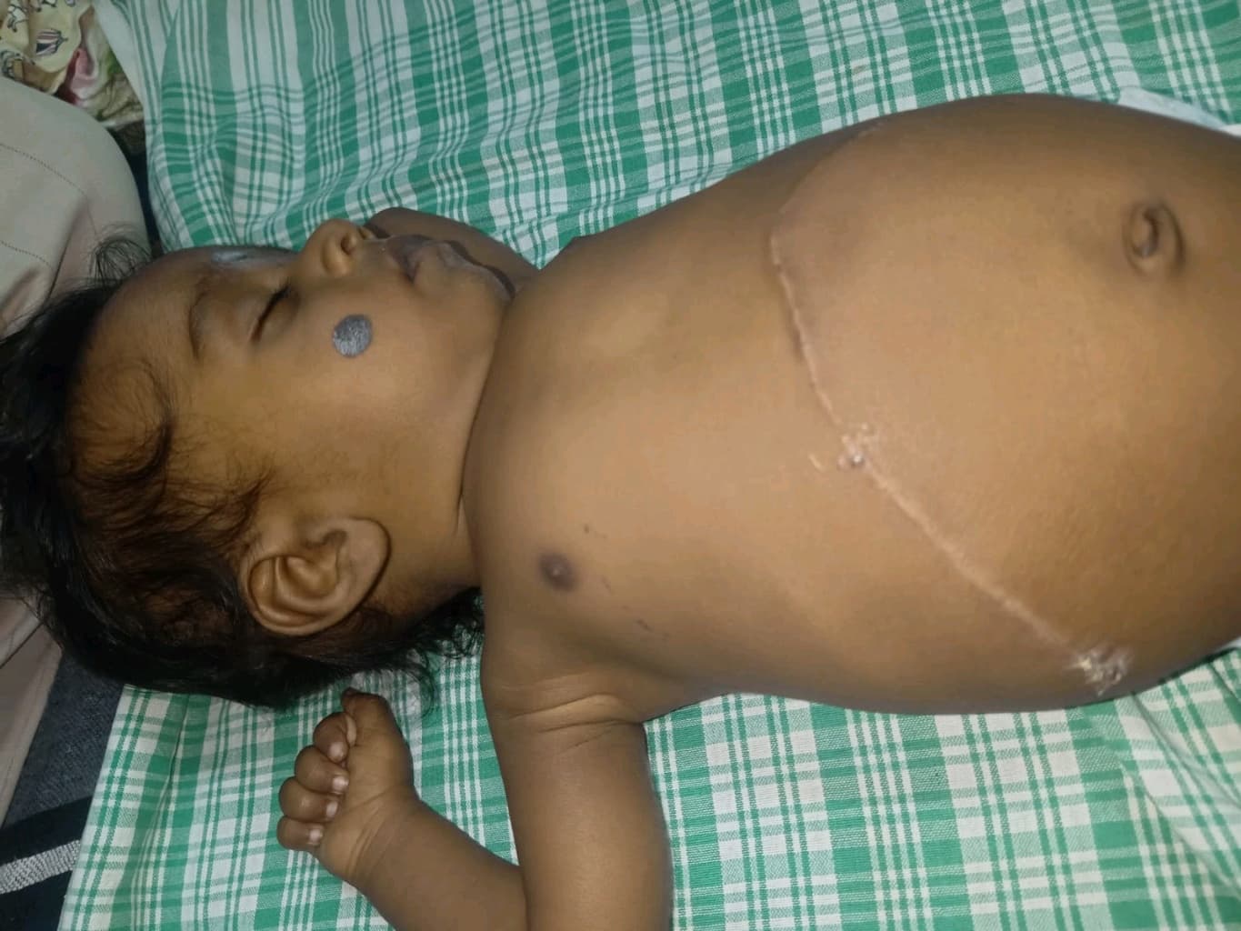 Help Our 4-Month-Old Baby Boy Needs to Undergo Liver Transplantation